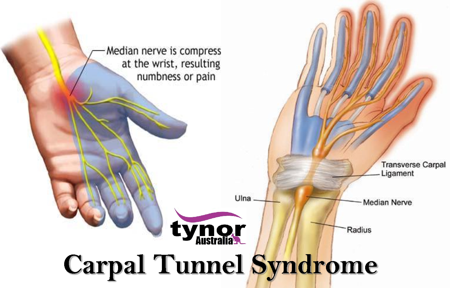 WHAT IS CARPAL TUNNEL SYNDROME?