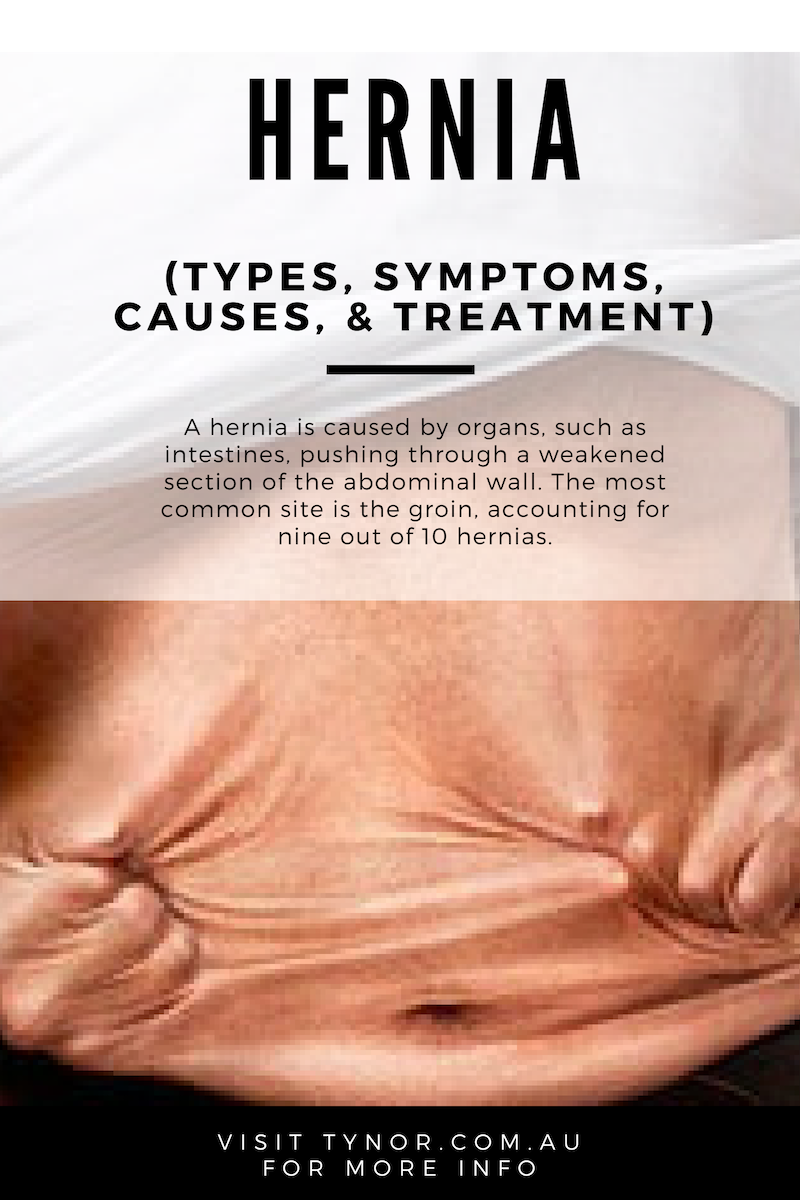 Hernia- Types, Symptoms, Causes, & Treatment