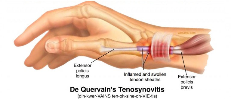 De Quervain’s Tenosynovitis Wrist brace Australia