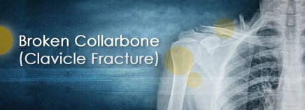 Clavicle Fracture Signs and Symptoms A clavicle fracture is typically associated with extreme pain, and arm movement is difficult. The clavicle bone lies just beneath the skin, so a fracture usually causes an obvious protrusion or bump at the fracture sit