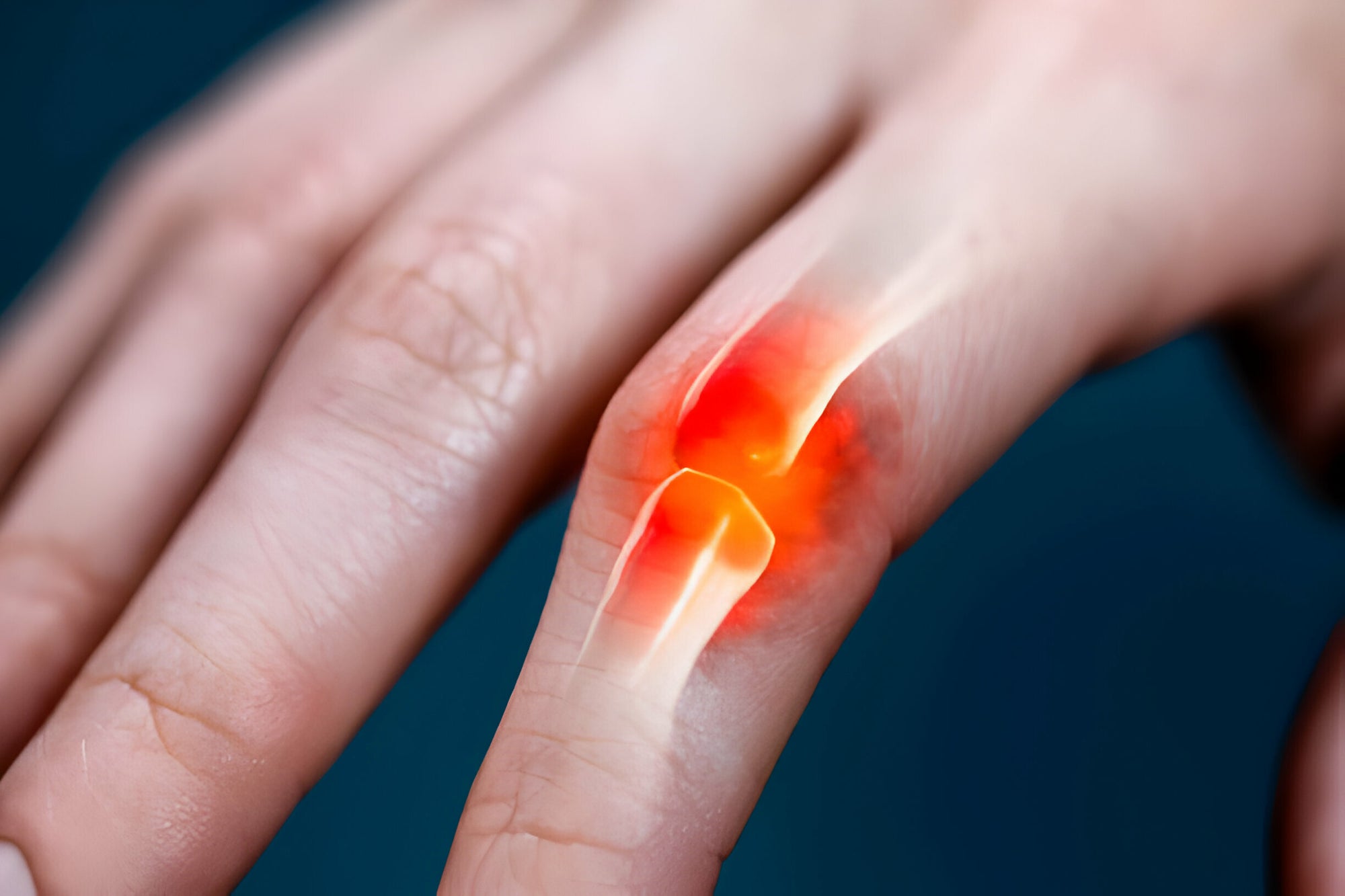 Trigger Finger Causes, Signs, Symptoms and Treatment