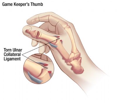 Gamekeeper's Thumb Splint Treatment for MCP Joint