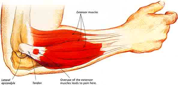 Are you cursed by tennis elbow?